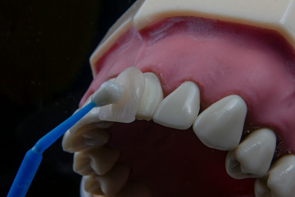 Dental Veneers Cost