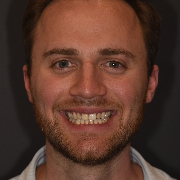 SLPDOTP - younger man before