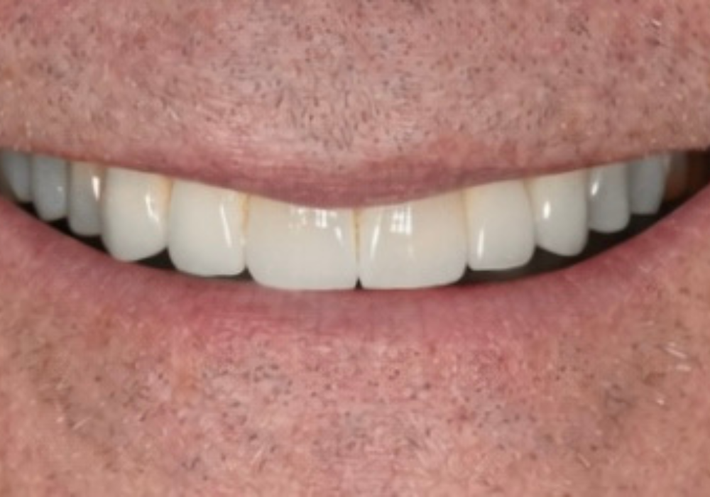 after veneers