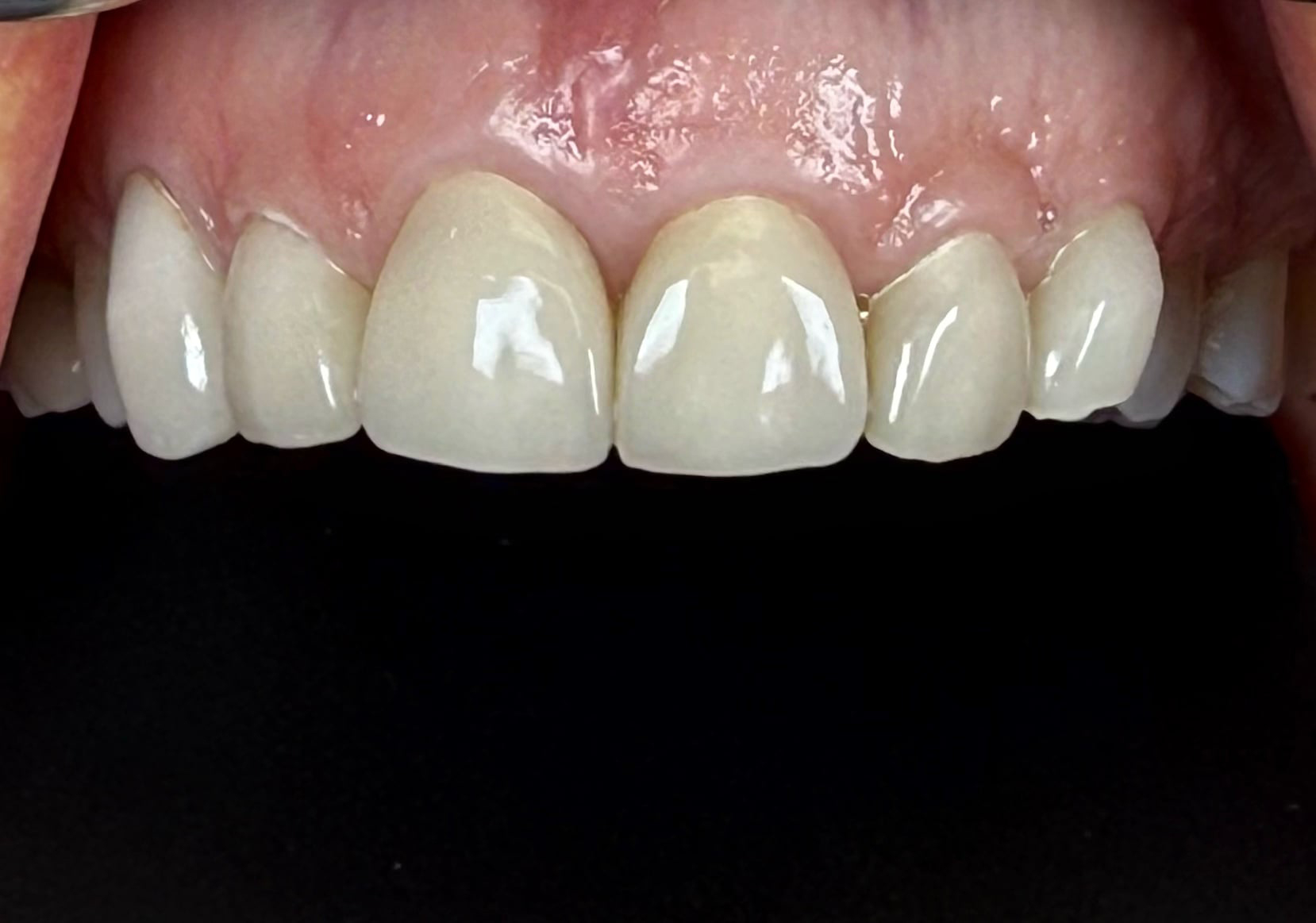 teeth before teeth before